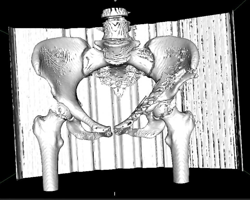 ՔԱՑԱԽԱՓՈՍԵՐԻ ԲԱՐԴ ՎԻՐԱՀԱՏՈՒԹՅՈՒՆ ԱՐԹՄԵԴՈՒՄ